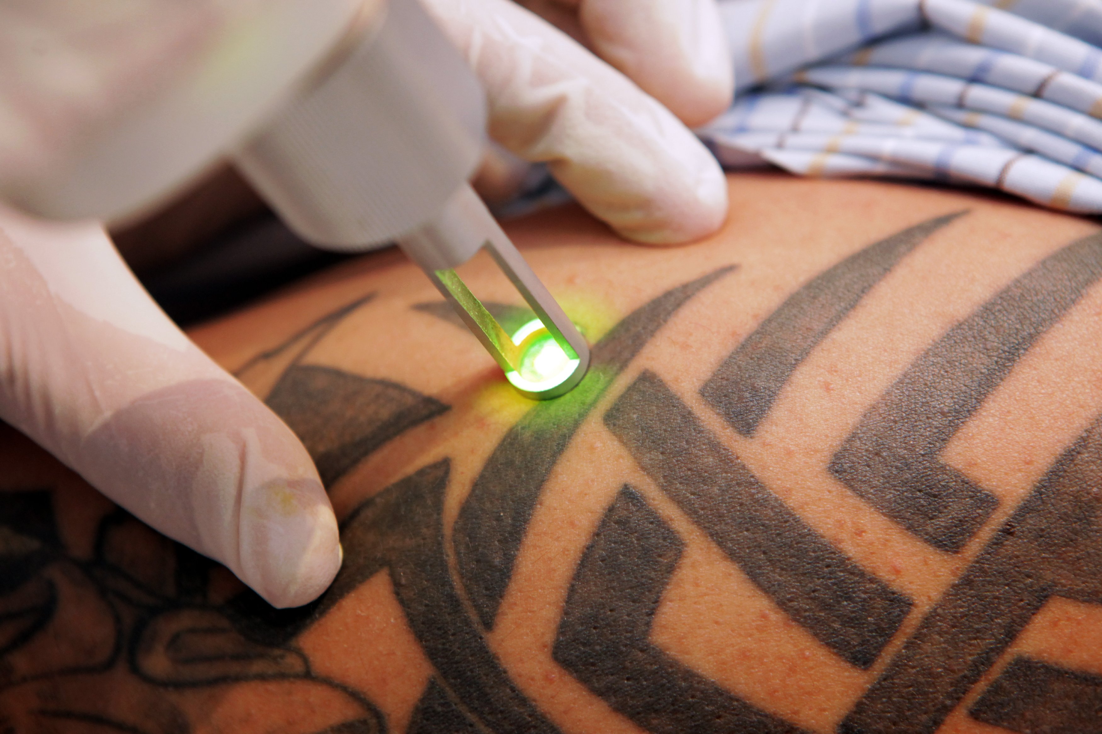 Tattoo Removal | Laser Tattoo Removal | Bristol