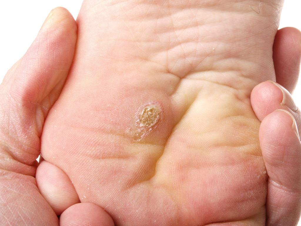 Wart and verruca removal Bristol
