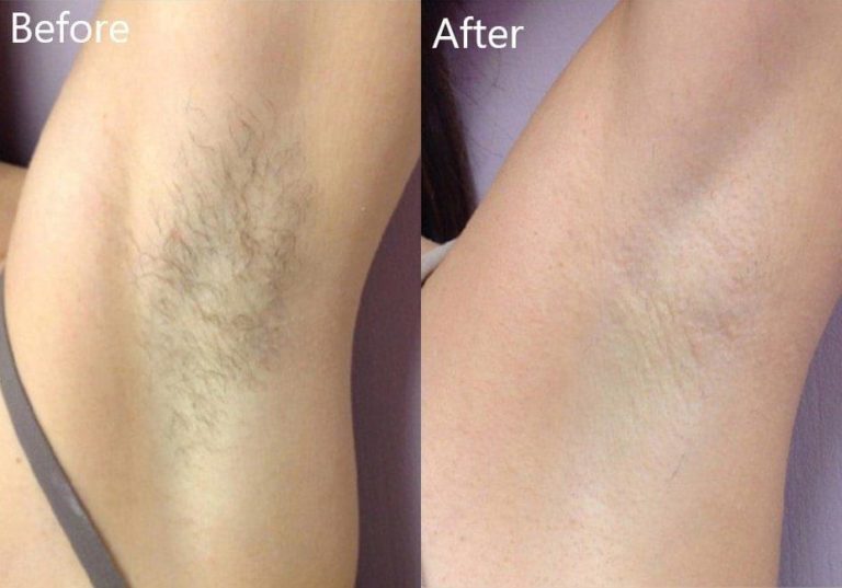 Laser hair removal before and after