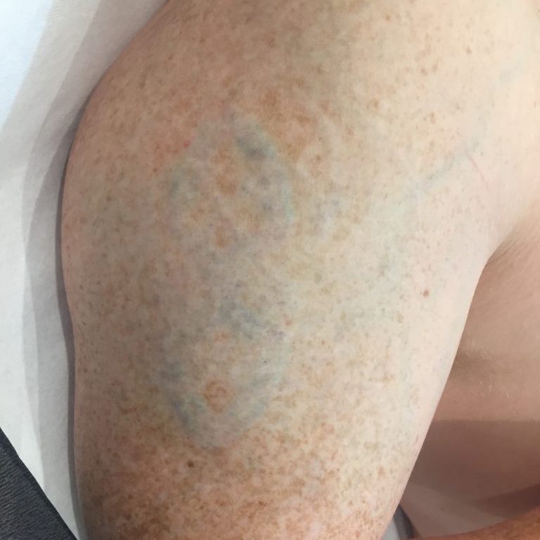 Laser tattoo removal Bristol after treatment, upper arm tattoo