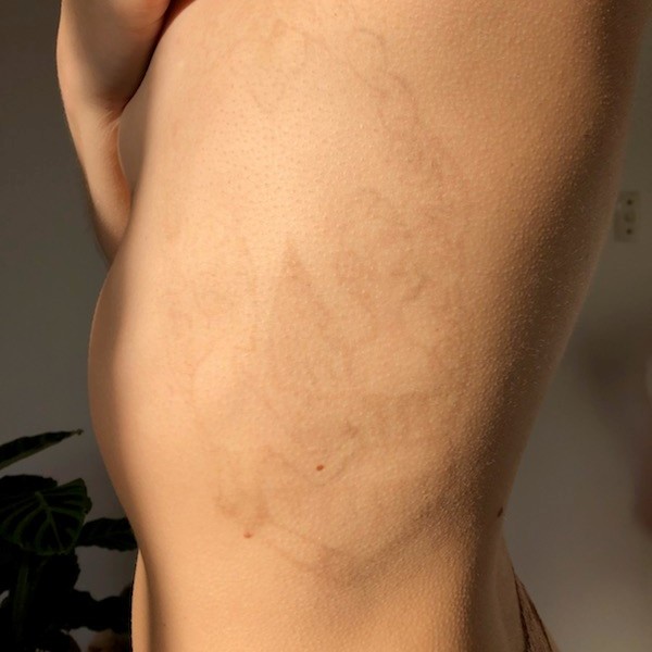 Laser tattoo removal after