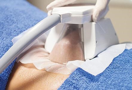 Cryolipolysis (Fat Freezing)