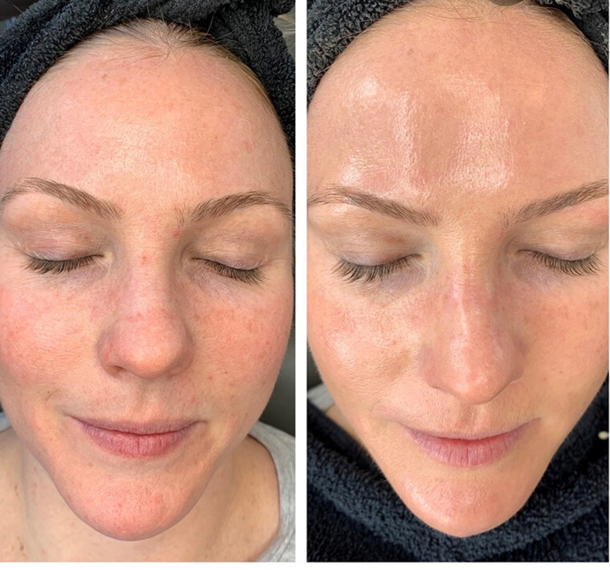 Hydrafacial before and after
