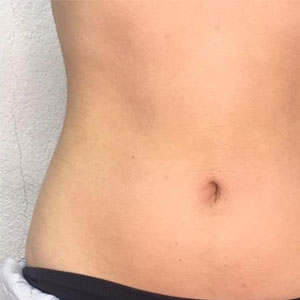 Fat freezing after