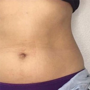 Fat freezing before