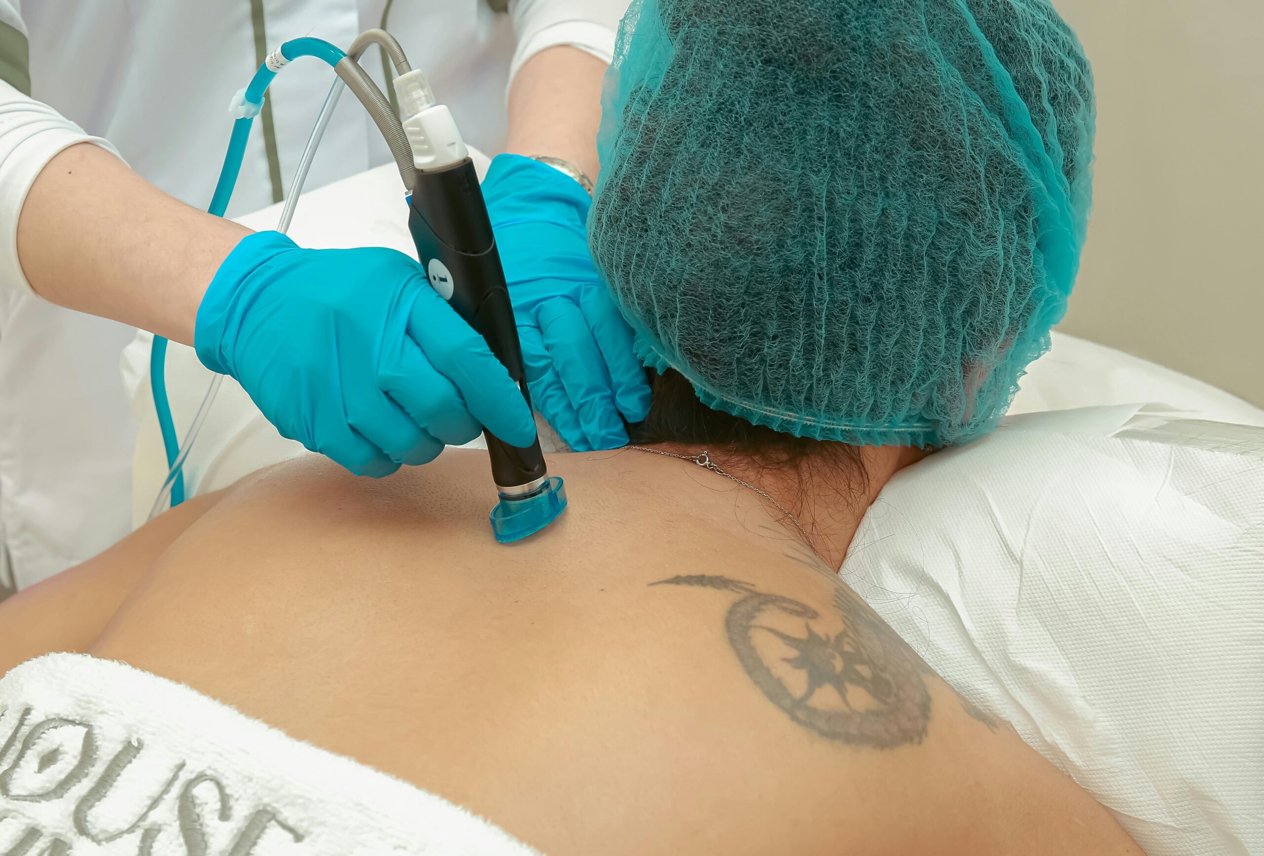 laser tattoo removal Bristol laser tattoo removal Bristol