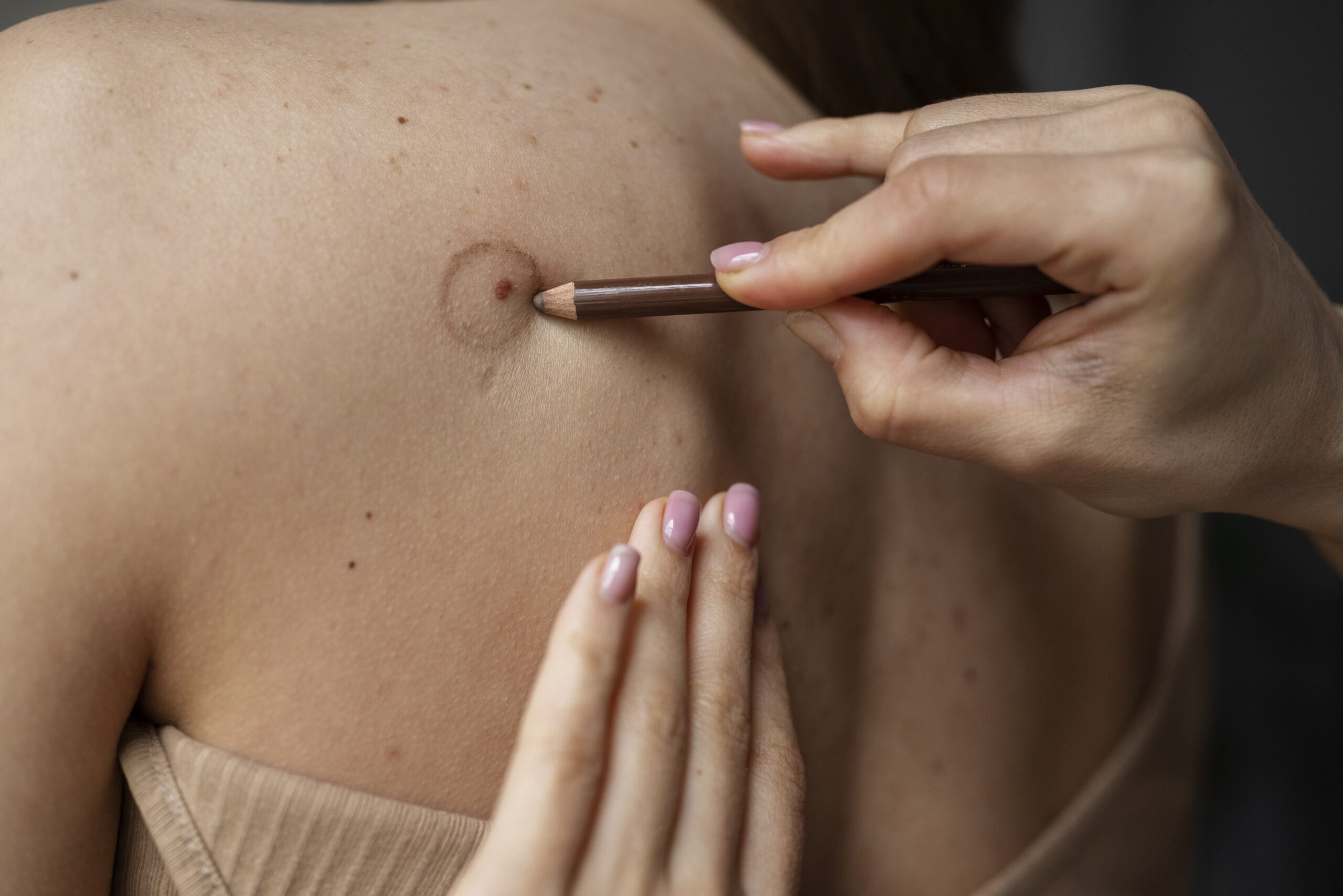 skin tag removal Bristol