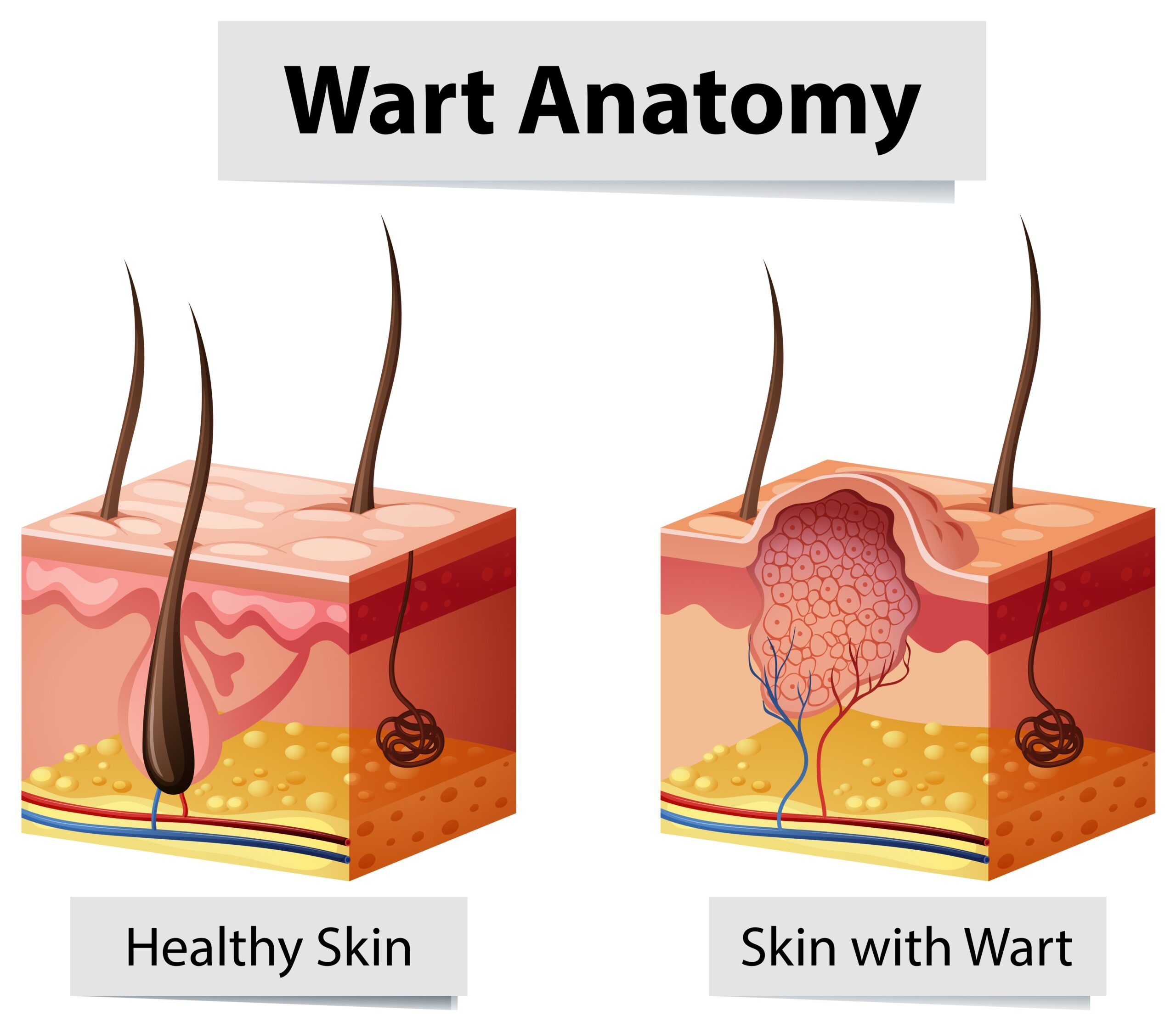 wart removal Bristol wart removal Bristol