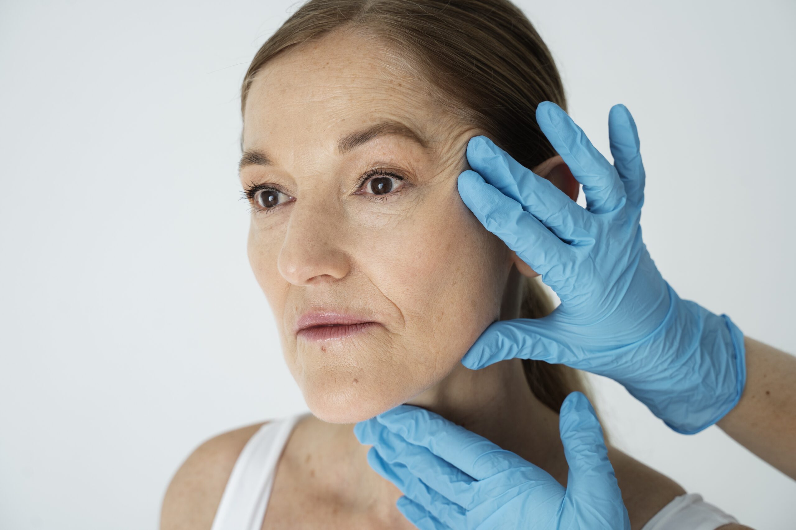 laser age spot treatment Bristol