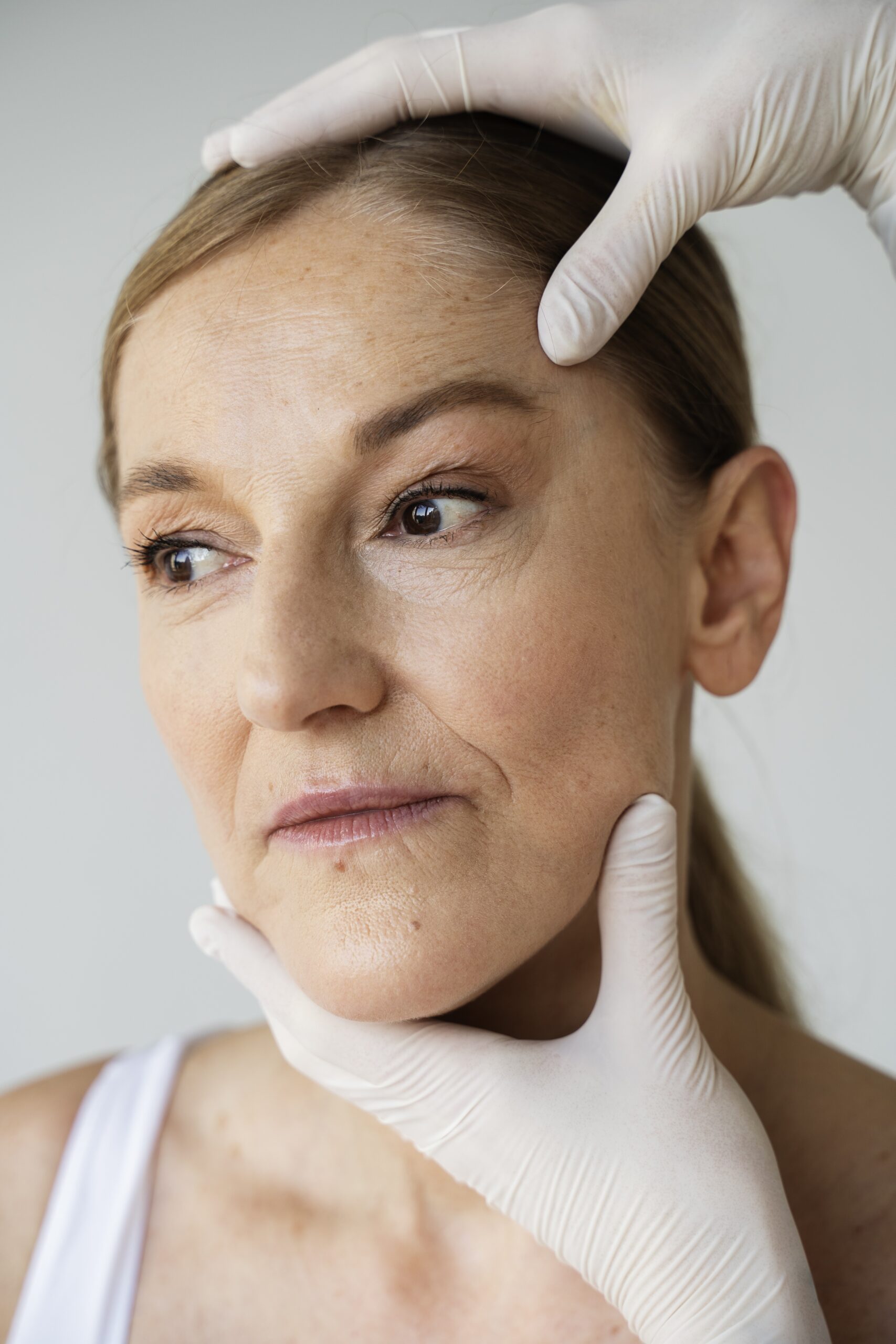 age spot removal Bristol