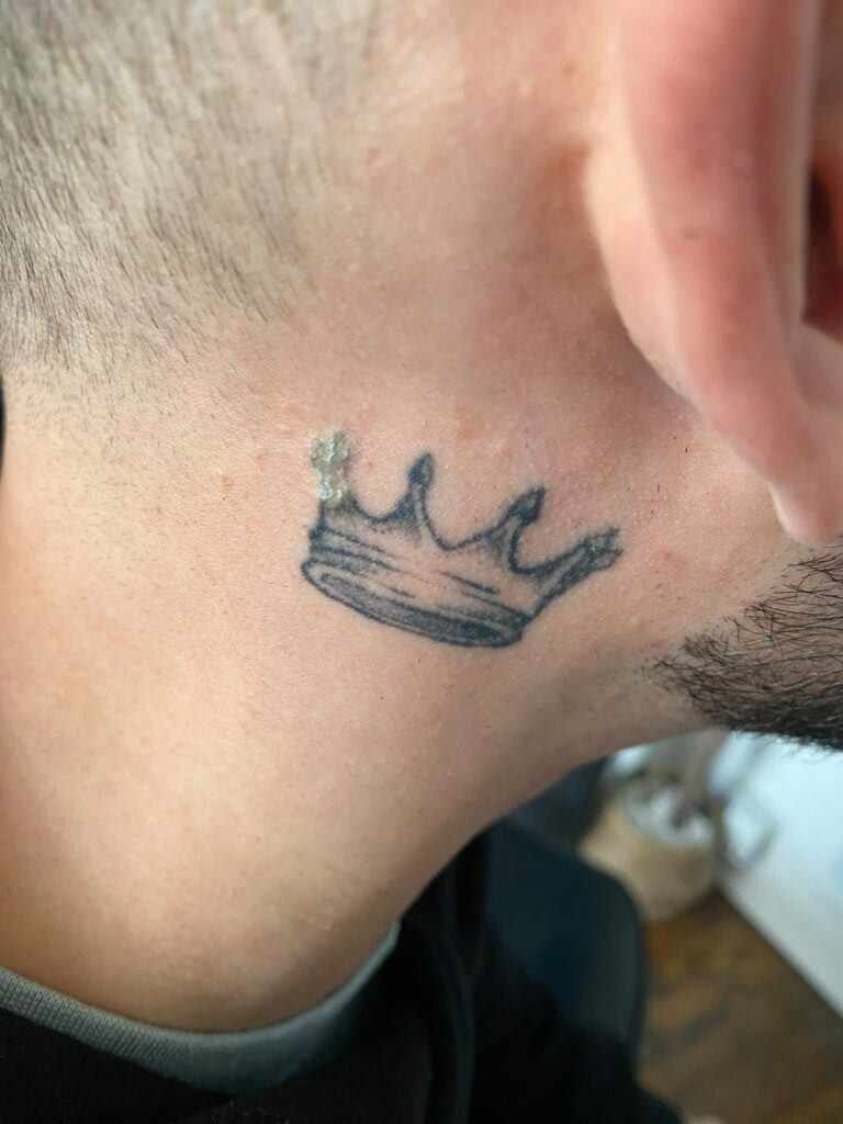 Tattoo removal Bristol